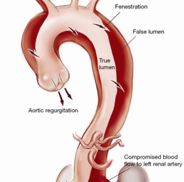 infrarenal aortic dissection