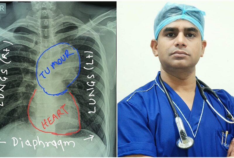 प्रदेश में पहली बार मेडियस्टाइनल हाइडेटिड सिस्ट की सर्जरी, 2 महीने से खांसी एवं सांस लेने में हो रही थी परेशानी