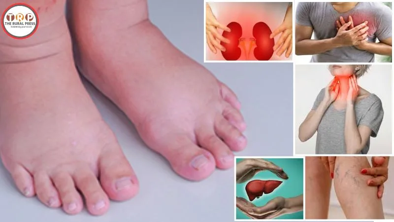 Symptoms of swollen feet related to heart and kidney diseases.