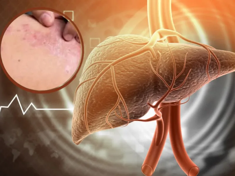  Liver Damage Warning : त्वचा में दिखने वाले इन 5 बदलावों को न करें नजरअंदाज