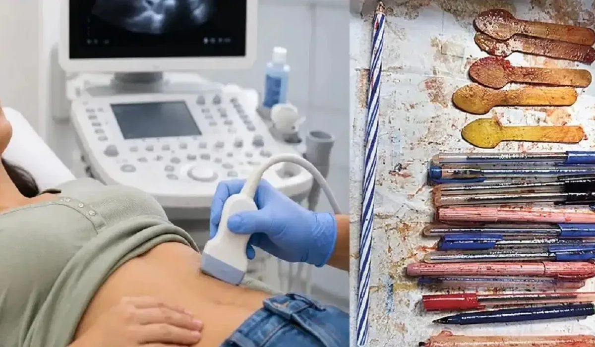 Doctors removing multiple foreign objects from a woman's stomach