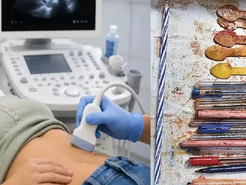 Doctors removing multiple foreign objects from a woman's stomach