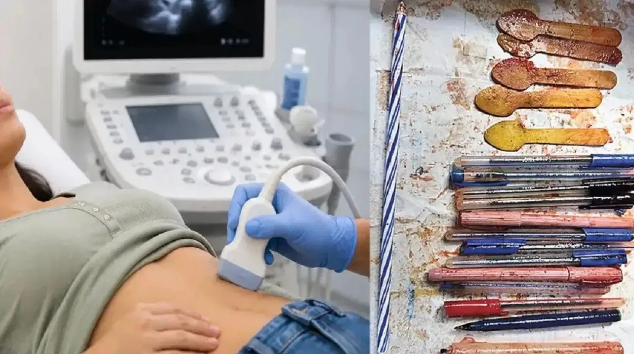 महिला के पेट से निकली 25 सेंटीमीटर का पेन और मोमबत्ती, डॉक्टर भी रह गए हैरान