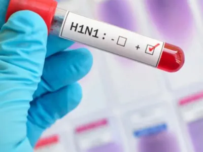 Chhattisgarh Swine Flu H1N1: छत्तीसगढ़ में H1N1 स्वाइन फ्लू मरीजों का आंकड़ा 176 पार, जानिए अपने जिले का हाल